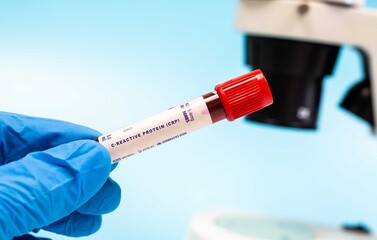 Obraz premium Measures the level of CRP in blood, indicating inflammation,