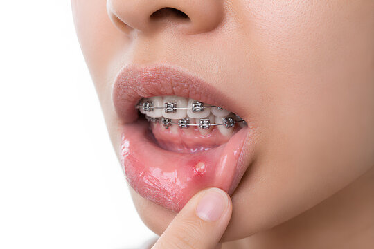 Woman showing mouth ulcer inside lower lip while wearing dental braces