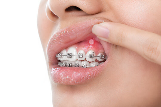 Woman showing canker sore on upper gum while wearing orthodontic braces
