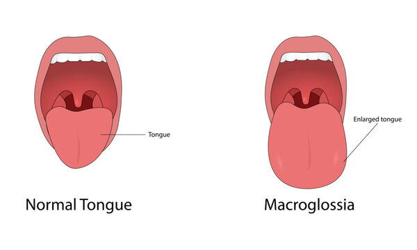 Macroglossia vector illustration