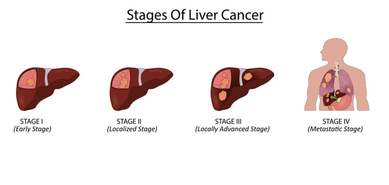 Stages of liver cancer vector illustration