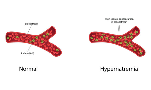 Hypernatremia vector illustration