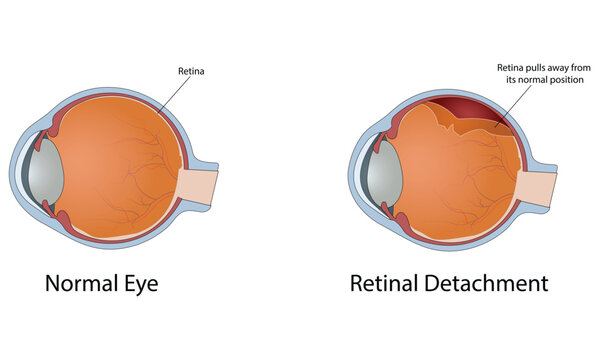 Retinal detachment vector illustration
