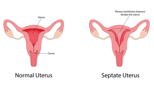Uterine septum vector illustration 