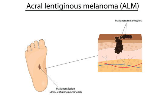 Acral Lentiginous Melanoma (ALM) vector illustration