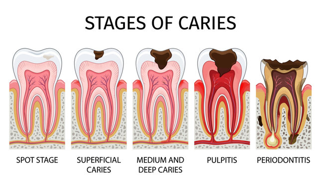 Infographic illustration showing stages of tooth decay, from spot to periodontitis.