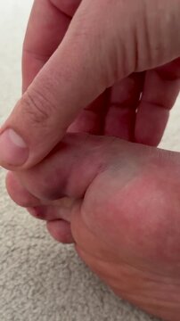 Close-up of human foot with visible bruising as hand examines injury, focusing on toe and surrounding area on soft carpet surface in indoor setting