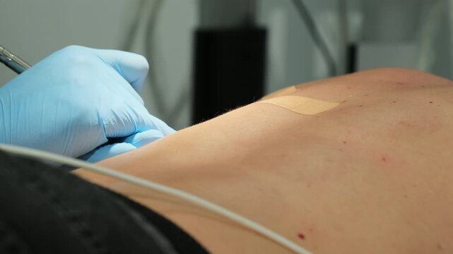 Surgeon in gloves removes skin spots with laser coagulation in clinic slow motion. Doctor removes moles from patient back in hospital closeup