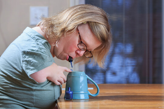 Woman with TAR Syndrome painting her nails at home