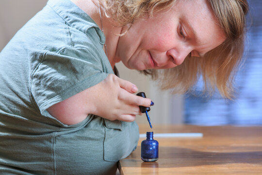 Woman with TAR Syndrome painting her nails at home