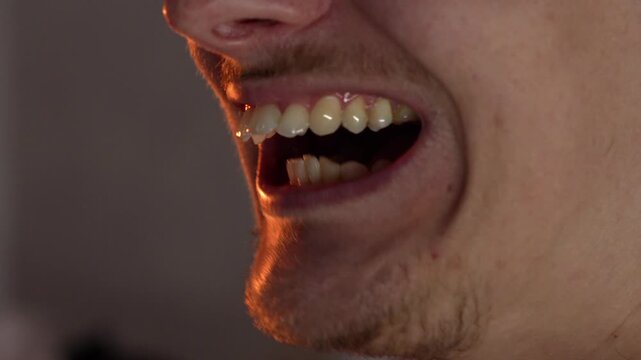 Protruding teeth in a man.
Malocclusion, large jaw