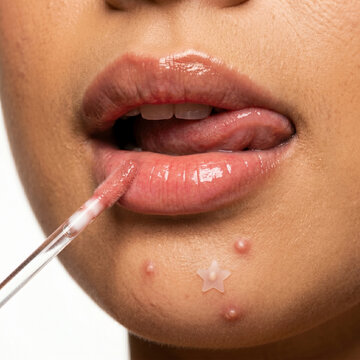 Close up of woman applying lip gloss with acne and pimple patch on chin