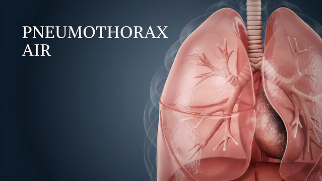 Pneumothorax condition with air in pleural cavity of lungs and trachea  medical health concept