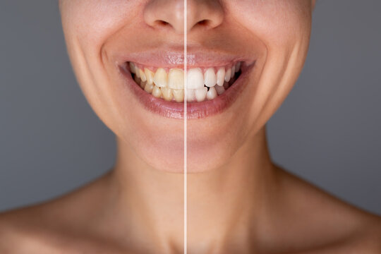 Before and after close up of woman's smile showing yellow and white teeth comparison. Dental whitening, oral care and cosmetic dentistry concept