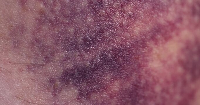 A large purple bruise, a painful bruise on the skin, reflects the effects of a recent physical injury