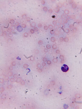 Trypanosoma cruzi Trypomastigotes and Amastigotes in Blood Smear Under Giemsa Stain