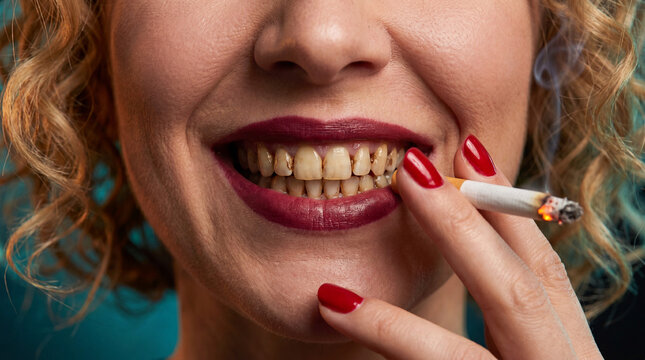 Woman with yellow stained teeth holding cigarette showing tobacco damage