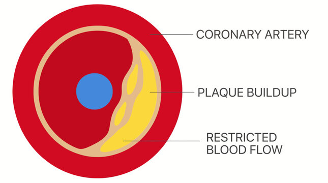 Atherosclerotic Plaque Buildup Inside Coronary Artery Cross Section