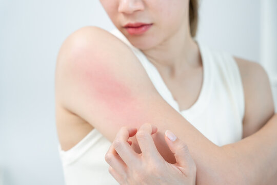 skin problem and beauty. woman scratch body has itchy skin from skin allergic, steroid allergy, sensitive skin, red from sunburn, chemical allergy, rash, insect bites, Seborrheic Dermatitis.