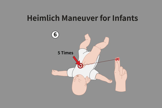 Heimlich Maneuver for Infants illustration 06