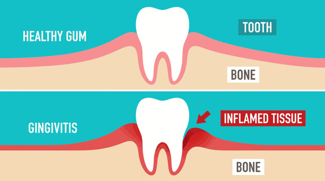 Gingivitis Inflamed Gum Tissue Diagram