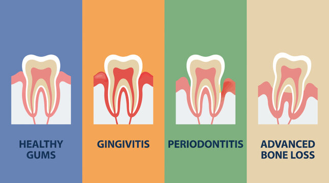 Periodontal Disease Bone Loss Progression