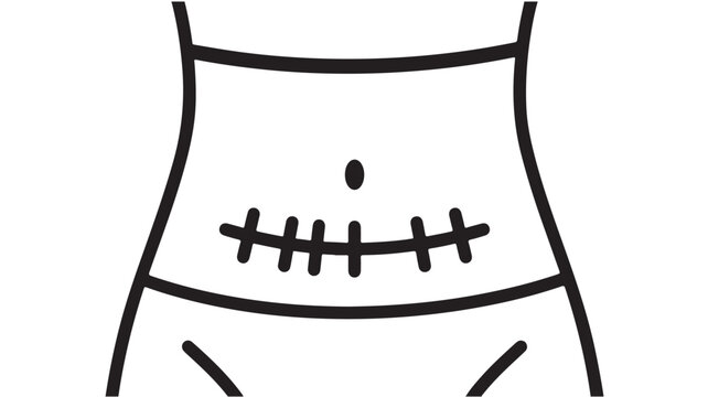 Surgical scar on female abdomen vector icon, cesarean section incision line art, medical surgery stomach wound illustration for healthcare