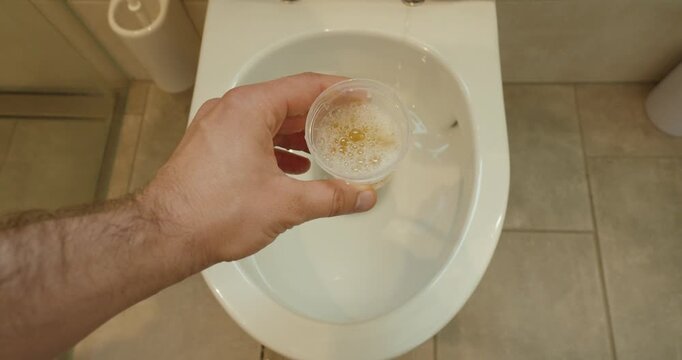 POV stock video showing urine being collected directly into a specimen cup above a toilet. Suitable for urine analysis, drug testing, toxicology screening, medical diagnostics, laboratory procedures,