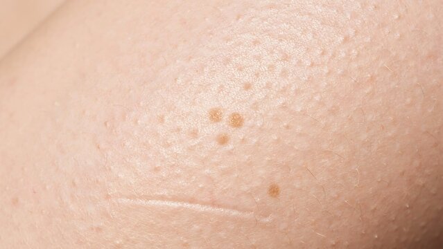Close up of human skin with moles and freckles on surface
