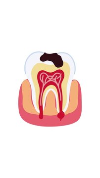 animation dental cavity formation inside human tooth