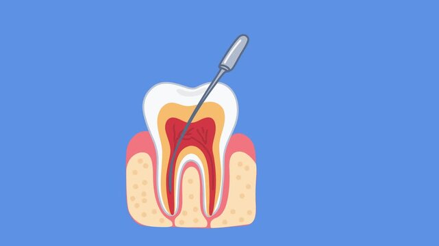 animation infected tooth canal cleaning and disinfection