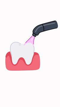 animation dental led curing lamp activating composite restoration