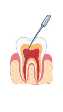 animation root canal cleaning procedure on white background