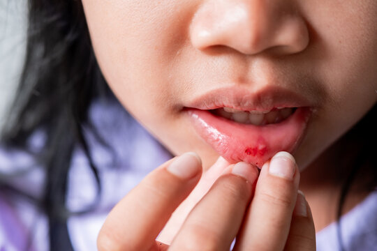 Close-up of a parent's hand gently checking a painful mouth ulcer or canker sore on a child's lower lip. Ideal for medical, pediatric healthcare, oral hygiene, and dental care concepts.