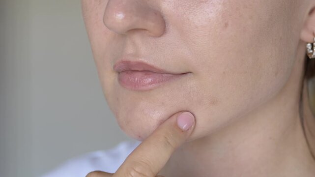 Young woman placing hydrocolloid patch on acne spot on chin in close-up view with natural skin texture. Skincare concept for dermatology clinics, beauty brands and pharmacy marketing.