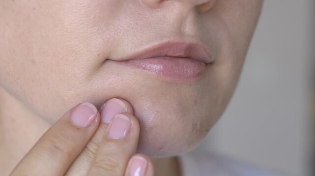Woman applying transparent hydrocolloid patch on acne spot on chin in soft daylight. Realistic skincare footage suitable for dermatology clinics, pharmacy advertising and beauty brands.