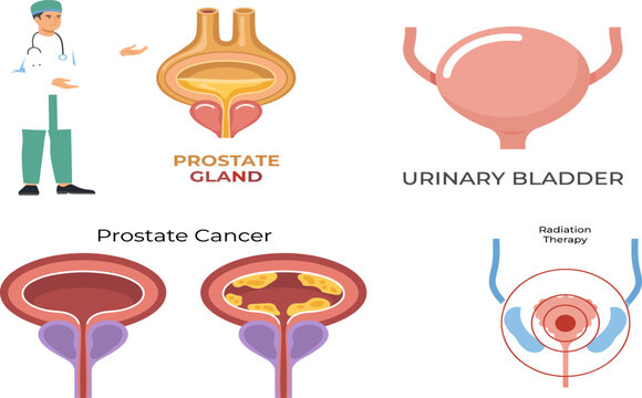 Prostate Gland Cancer and Urinary Bladder Medical Anatomy Vector Set with Doctor and Radiation Therapy for Healthcare Education Design