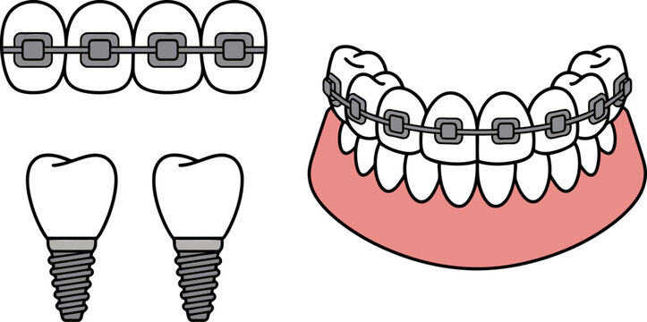 Cartoon dental implants and teeth with braces on a white background