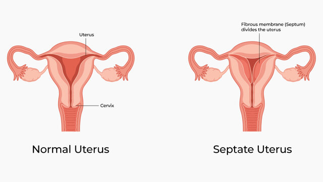 Comparison of Normal and Septate Uterus Anatomy