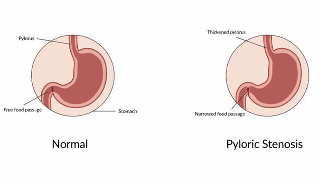 Medical Illustration Comparing Normal And Stenosed Pylorus