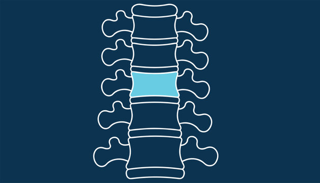 Spine anatomy diagram with a single vertebral disc highlighted in bright blue to represent herniated disc pain.