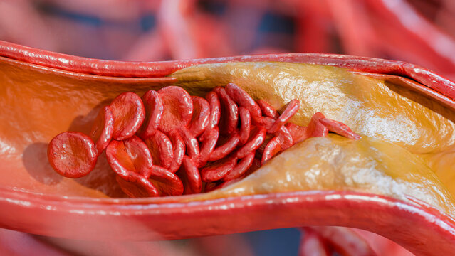Cholesterrol or Atherosclerotic Plaque in blood vessels, Blocked vessel stroke, Thickened Arteries and Veins, Coronary, fat buildup clogging, Atherosclerosis or atheromatous Hyperlipidemia, 3d render