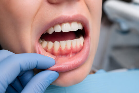 Labial Frenectomy and Periodontal Evaluation &ndash; Lip Tie Treatment, Gum Health & Pediatric Dental Care