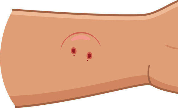 Medical vector illustration showing an insect bite or skin irritation with red inflamed puncture marks on a human arm.