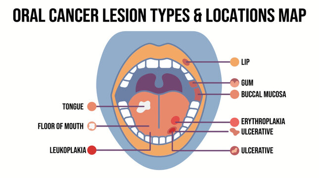 Oral Cancer Lesion Types and Locations Map