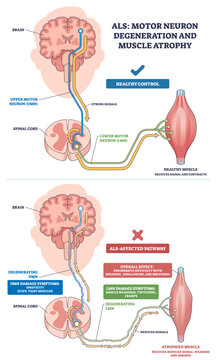 ALS motor neuron degeneration and muscle atrophy shown with brain, spinal cord, and muscle, contrasting healthy control with reduced signals and wasting in disease, transparent background.