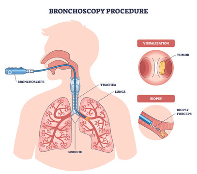 Bronchoscopy procedure illustrated, airflow pathway and tumor biopsy shown as a scope passes through trachea into lungs, key elements are bronchoscope, bronchi, biopsy forceps, transparent background.