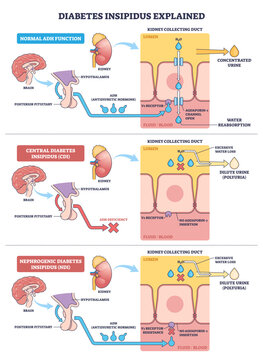 Diabetes insipidus explained, brain, kidney, and collecting duct show ADH pathway, contrasting water reabsorption with dilute urine and polyuria outcome, transparent background