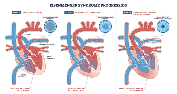 Eisenmenger progression, flow shifts from left-to-right shunt to pulmonary hypertension and final shunt reversal, heart, pulmonary artery, arterioles, transparent background