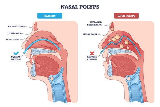 Nasal polyps brief overview showing healthy vs polyp-filled sinuses, with airflow arrows illustrating obstruction, key elements, nasal cavity, polyps, inflamed lining, transparent background